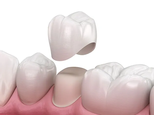 Illustration of a dental crown