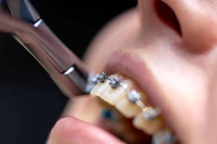 Close-up of braces on teeth